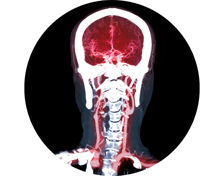 beyin damar baloncuğu