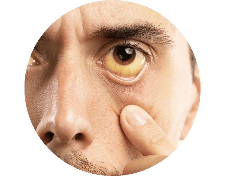 bilirubin yüksekliği