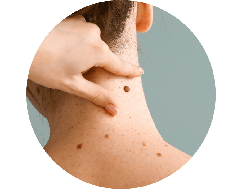 lazerle et beni alma