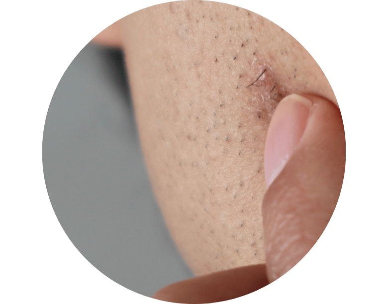 kıl dönmesi tedavisi