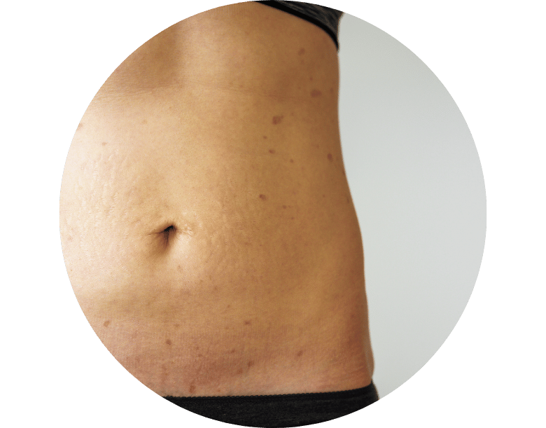 liken planus tedavisi