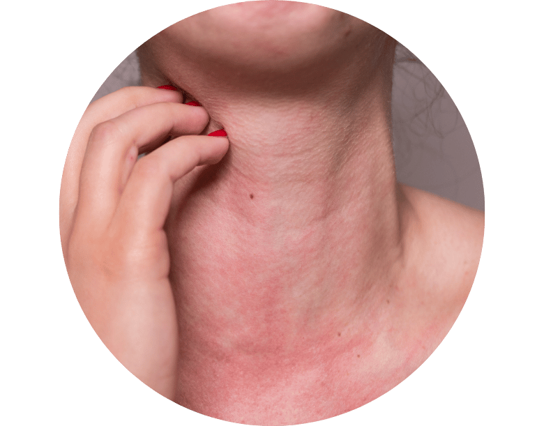 antibiyotik alerjisi belirtileri